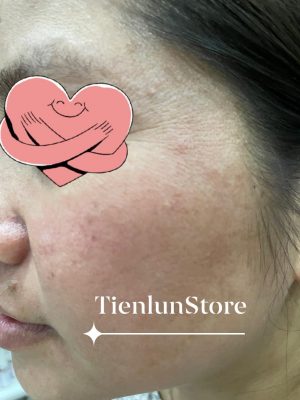 Mảng nám bay khoảng 90% rồi. Kiên trì thêm 2 tháng nữa sẽ đẹp