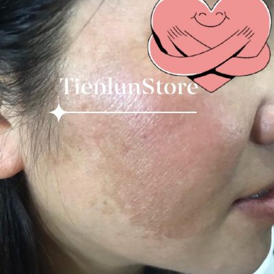Trị nám cùng Obagi Medical